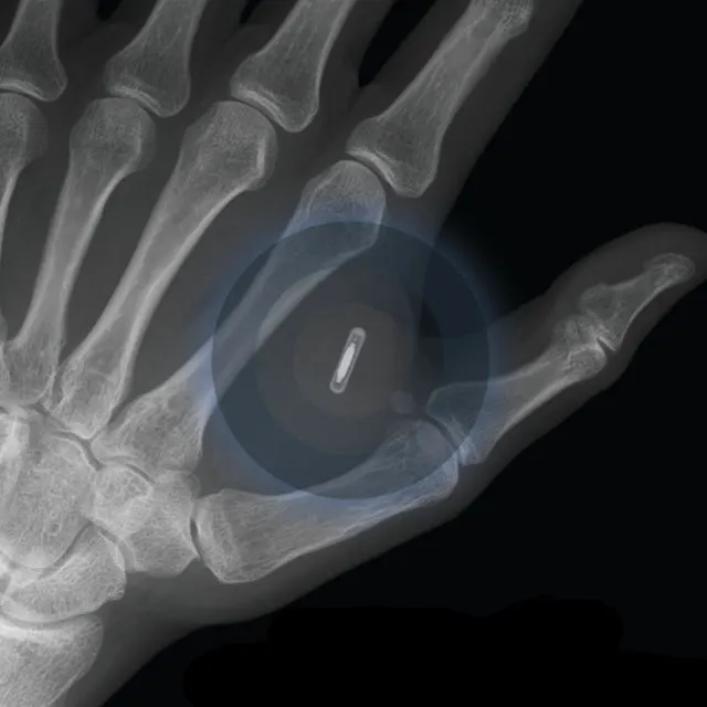 X-ray of a hand with a subdermal implant